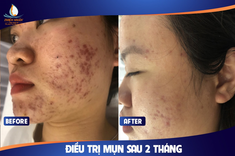 Spa trị mụn 