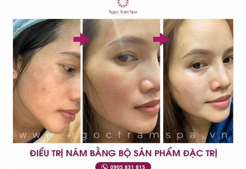 Spa trị mụn 