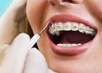 Top 10 địa chỉ niềng răng trả góp Đà Nẵng uy tín hàng đầu