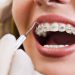 Top 10 địa chỉ niềng răng trả góp Đà Nẵng uy tín hàng đầu